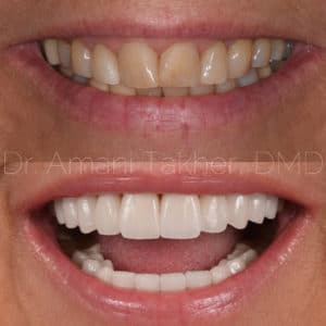 Vacaville Cosmetic Dentist Before And Afters Dr Amani Takher Dmd 1 300x300