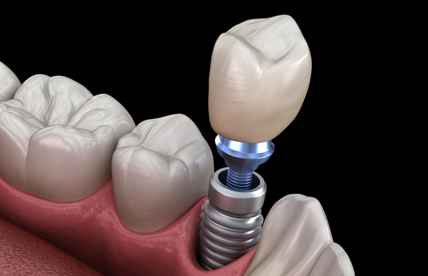 Why Are Dental Implants Needed